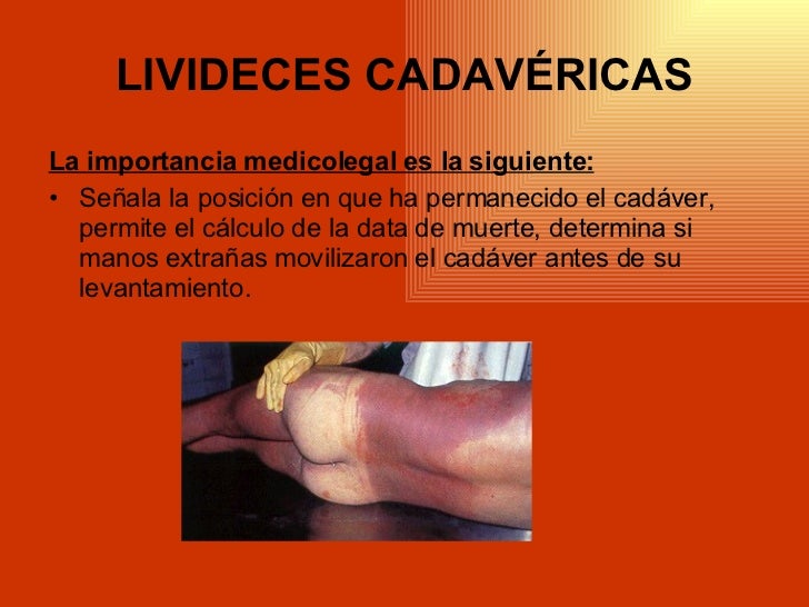 livideces cadavericas